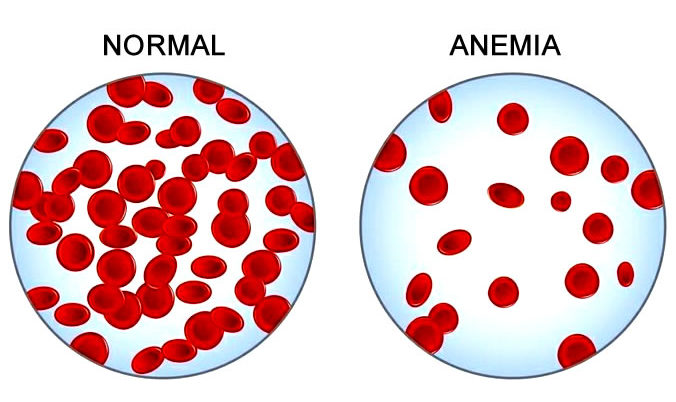 Anemia ilustração
