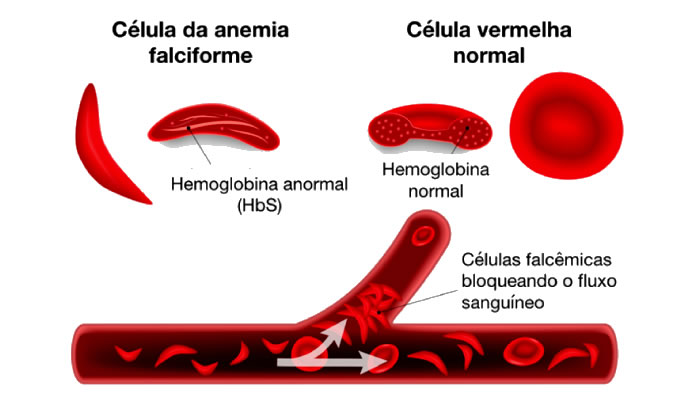 Esquema mostrando as células normal e falciforme