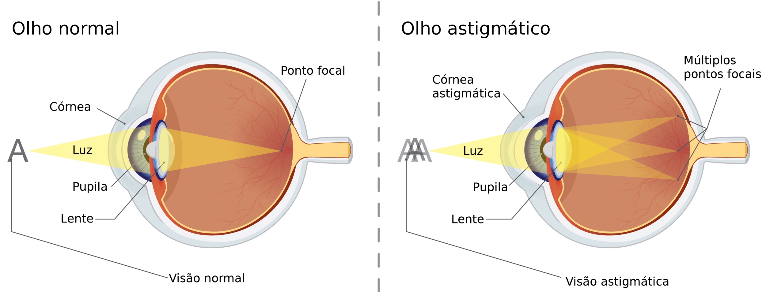 Olho com astigmatismo