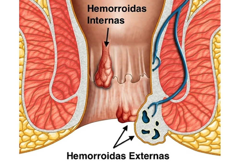 Hemorroida - Inflamações interna e externa