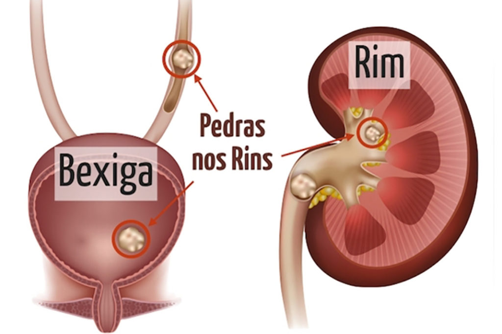 Pedras nos rins - Cálculo renal
