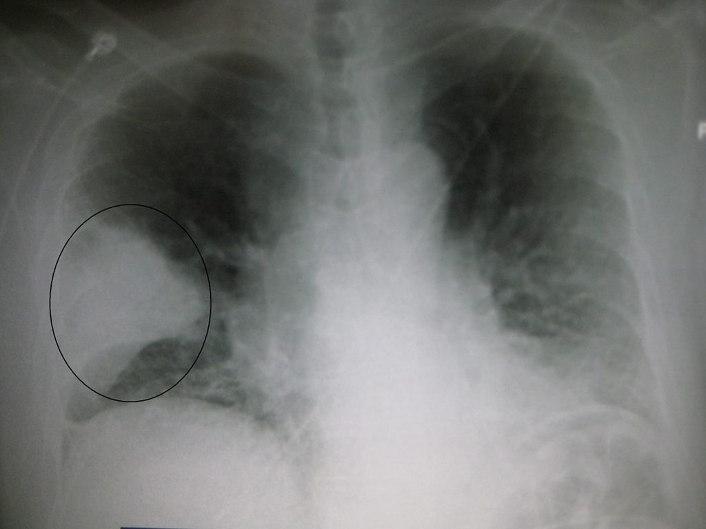 Pneumonia - Radiografia