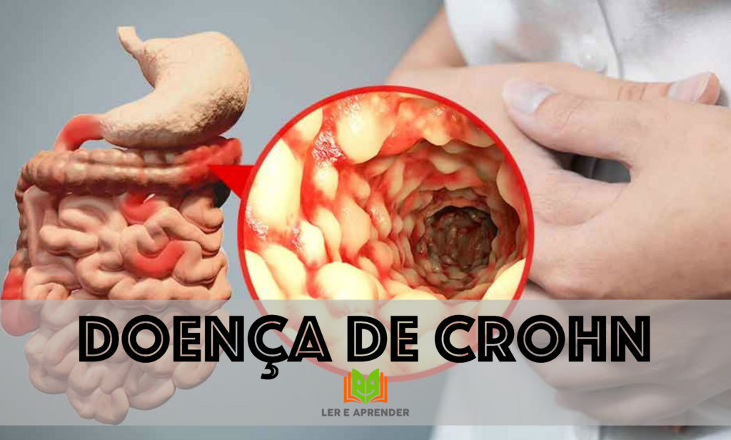 Doença de Crohn