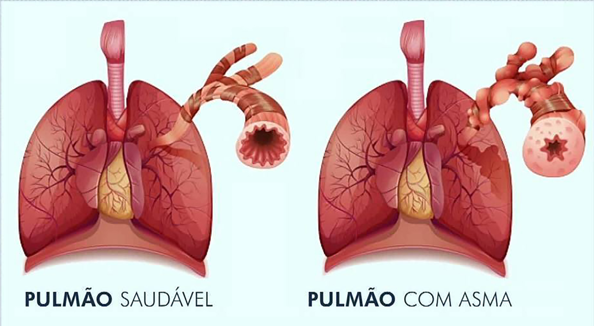 Asma - Anatomia do pulmão.